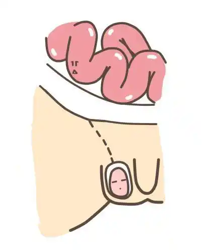 宝宝的蛋蛋肿了是怎么回事