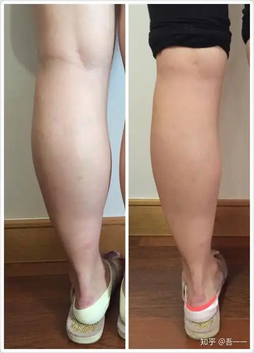 腓肠肌怎么瘦