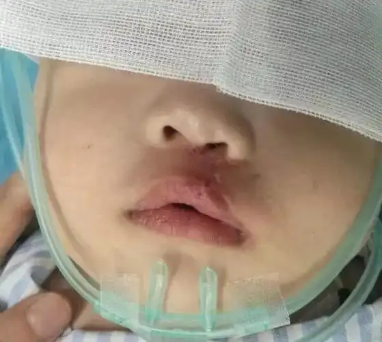 "兔唇宝宝"恢复美好笑容