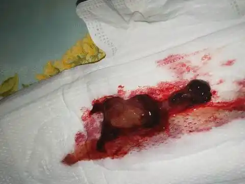 求助大家帮忙看一下怀孕10周,流血,流出来的是不是胚胎