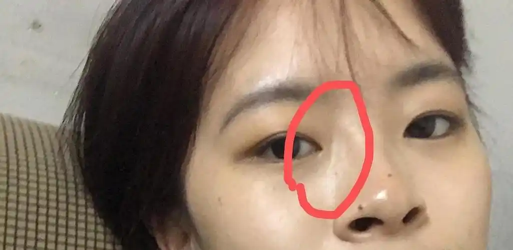 戴眼镜戴久了眼睛和鼻子变得很奇怪