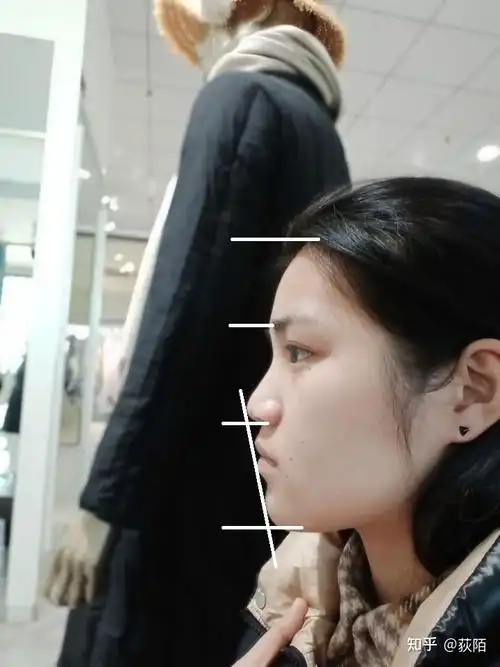 侧脸丑需要怎么改善