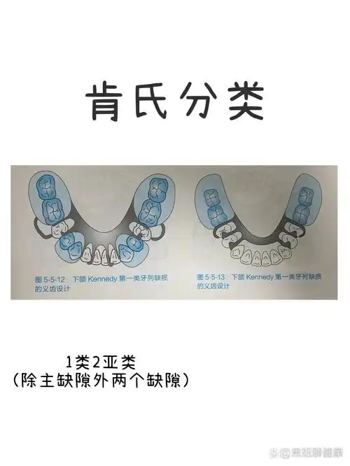 式,比如:多数牙缺失,个别前牙存留或余留牙健康较差时,不设计牙合支托