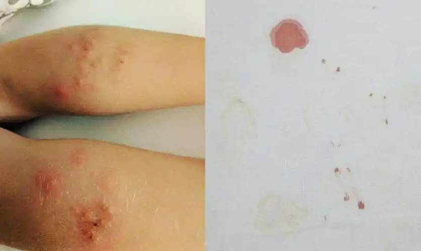 床虱咬到人的皮肤图片,床虱一般藏在哪里?