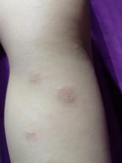 不痒痒 为您推荐: 其他回答 看起来比较像铜钱癣,建议带孩子去看医生