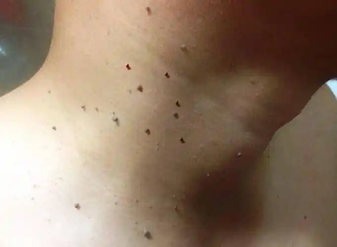 能用手揪掉吗?听听医生怎么说_病毒_皮肤_饮食