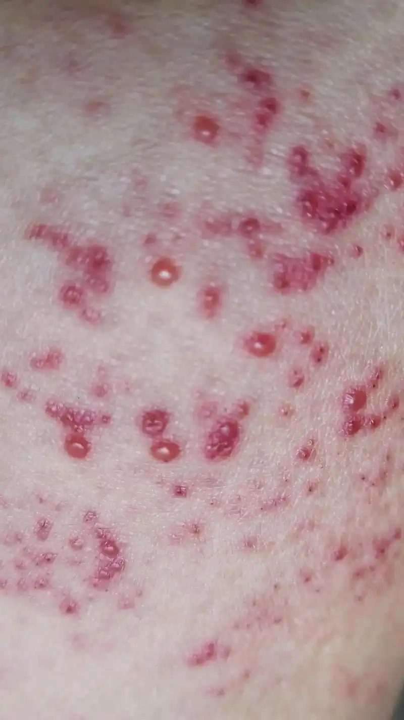 蛇缠腰 最近听到很多人长了蛇缠腰,分享个土方给大家,芭蕉的 - 抖音