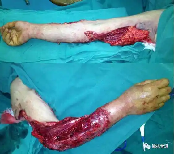 锐性彻底清创,珍惜组织;大量生理盐水冲洗,避免使用双氧水 严格止血