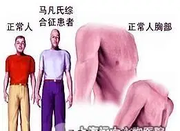 义务!马凡氏综合征"日新月异"-第1张图片-追风博客