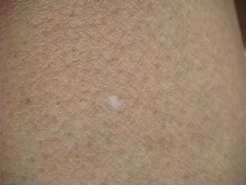 2013-08-15 12:40zhenfenglianhe|     分类:星座/运势 是汗斑吗?