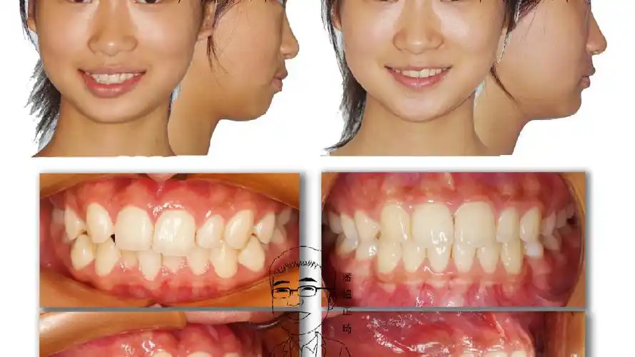 86期,缺一颗侧切牙,中线不齐,前突,拔牙矫