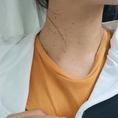 对抗丝状疣第三天