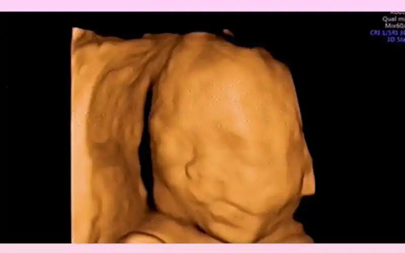 四维检查到唇腭裂的宝宝很难过