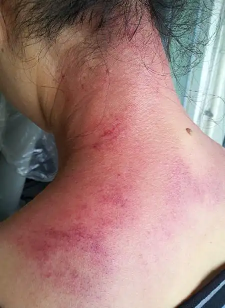 31别有病网第21期刮痧培训纪实