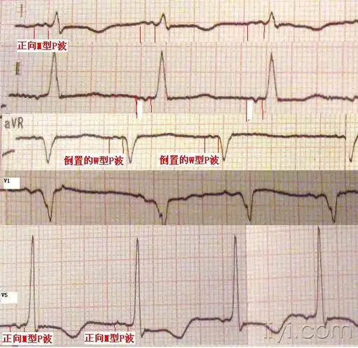 窦律,二尖瓣p波