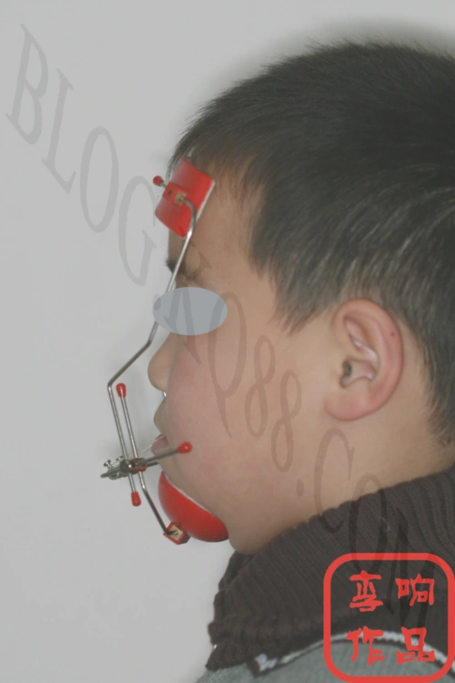 合畸形的儿童患者,可以在适当时机应用前方牵引的方法刺激上颌骨生长