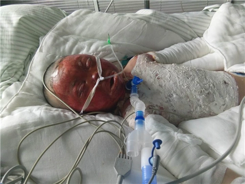 被烧伤的坚强女孩沈志瑶