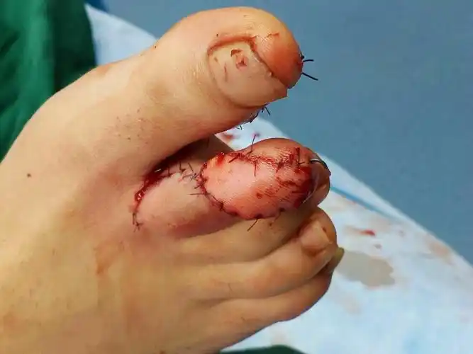 左示指砸伤后甲床坏死.勾甲畸形,指体短缩.