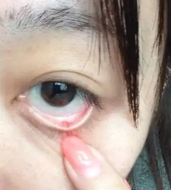 眼睛里长了个条状白色的东西,一碰就痛,跪求知道的大神给我解答下