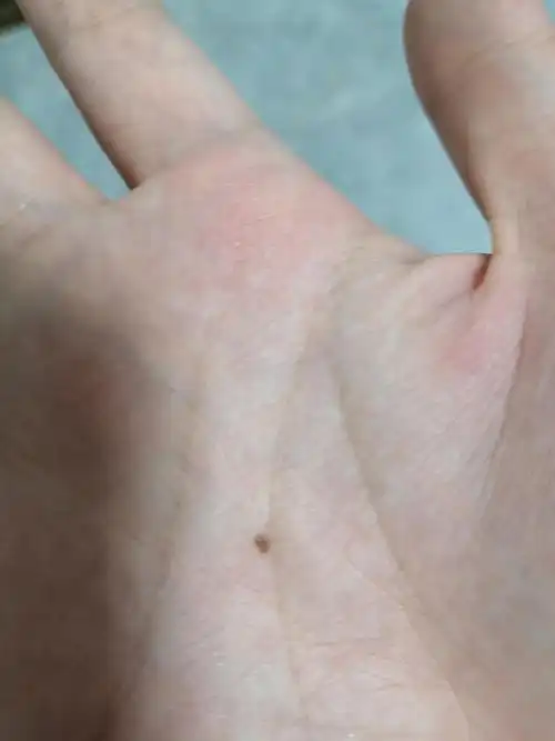 这是一个月前长的,右手,从一个点点变成这样