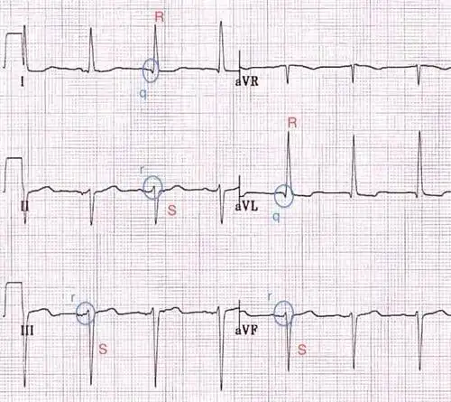 左前分支传导阻滞