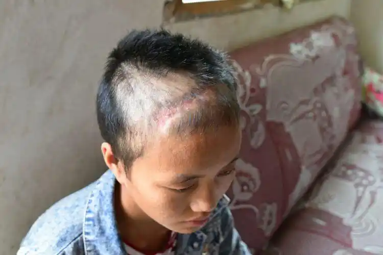 开颅留下的疤痕,手术非常成功,但由于是恶性的,所以也只能期盼奇迹