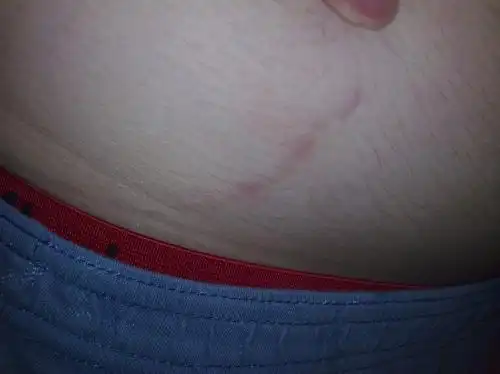 我肚子上长了一条类似疤痕的东西.越来越长.有人知道是什么吗?