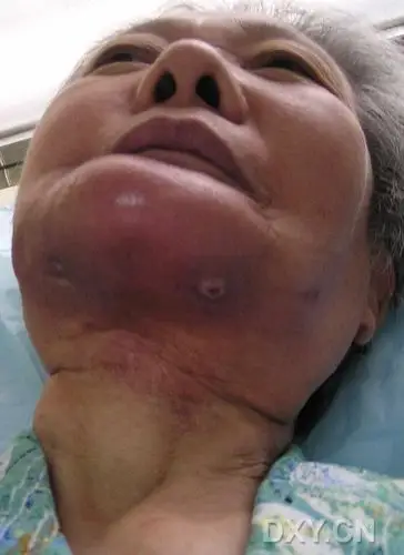 【病例讨论】下颌骨放射性骨髓炎,瘘管形成 [病例帖]