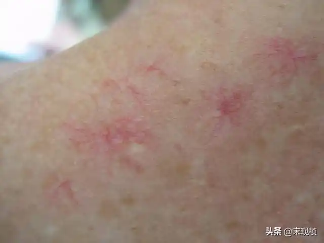 35岁男子皮肤上出现了这种小红点竟已肝癌晚期