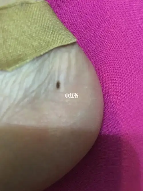 想问下这个脚后跟上的黑点(平的,不凸)需要去看医生不?