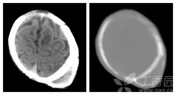 颅骨骨膜下血肿.