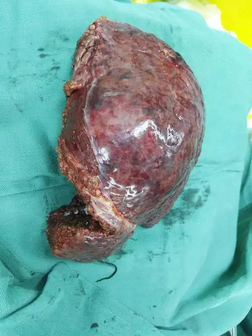 肝癌肝癌晚期介入手术意义到底大不大