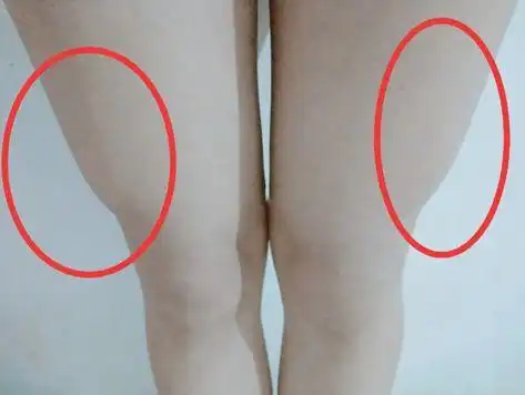 不要做受伤又粗腿的刘畊宏女孩|刘耕宏|髋关节|肌肉|腰椎_网易订阅