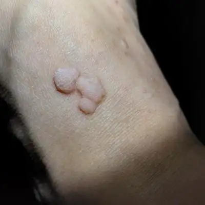 大蒜可以治扁平疣吗