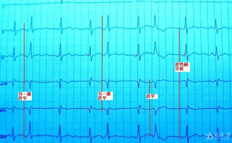 有p波的"室早",谁见过? - 心电图脑电图专业讨论版 - 爱爱医医学论坛