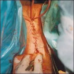 变性手术过程图示(男变女)