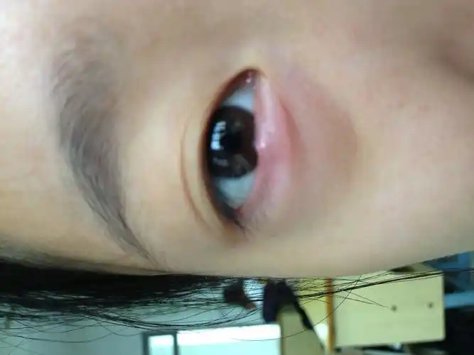 我这个眼睛算是长针眼了吗?