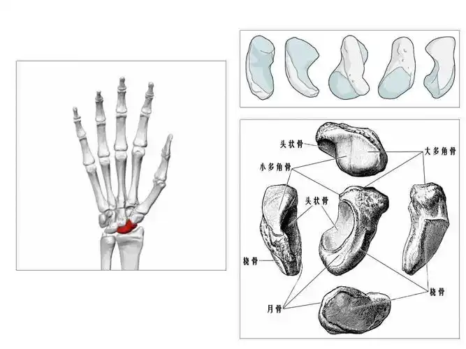 陈旧腕舟骨骨折处理