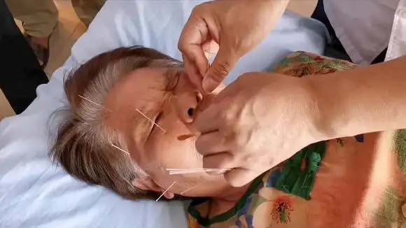 面瘫恢复期如何针灸在治疗,专家精讲如何选穴和进针,简单实用