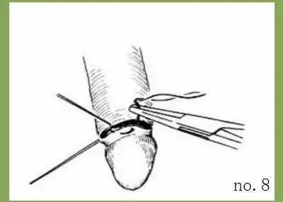 包皮过长手术过程(图片)_云南协和医院男科手机站