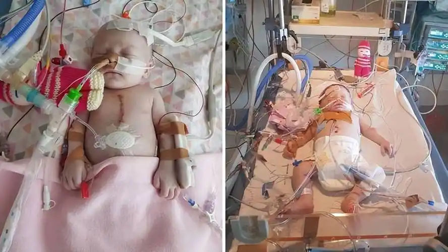 澳洲最坚强小女孩出生就只有半个心脏