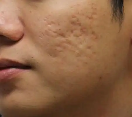 橘皮样皮肤图片45