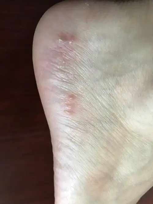 最近脚上长的,有点痒,还能忍受,不敢用药,也不知道啥东西,对