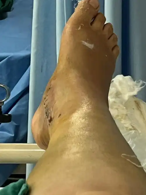 骨折术后伤口愈合不好