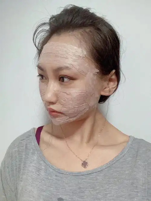 光子嫩肤术后1天