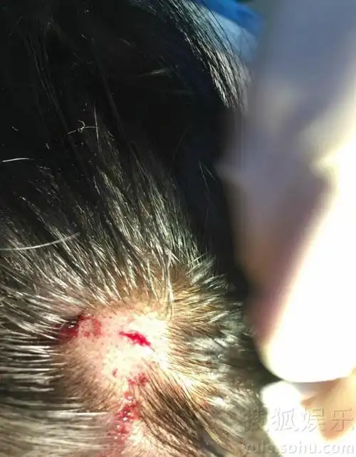 网曝黄灿灿拍戏被大灯砸伤 头部流血伤口一厘米