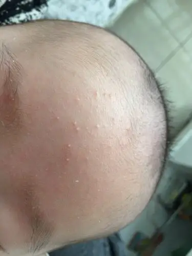 太热了 cn#baakbbgvav   2015-04-07 10:53 其他回答 那个是脂肪粒吧