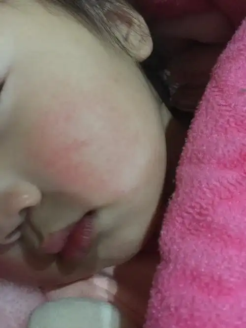 宝宝一岁两个月,最近脸突然很红就像图片这样,半个多月了一直没有好转