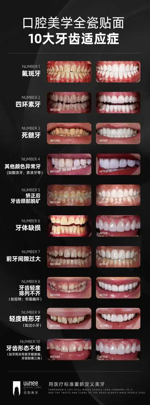 成都牙齿美容全瓷贴面
