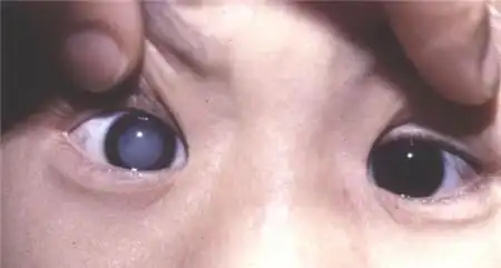 先天性白内障可能导致形觉剥夺性弱视